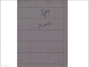 Дополнительные ЭКГ-отведения: ЭКГ на вдохе и ЭКГ при гипервентиляции