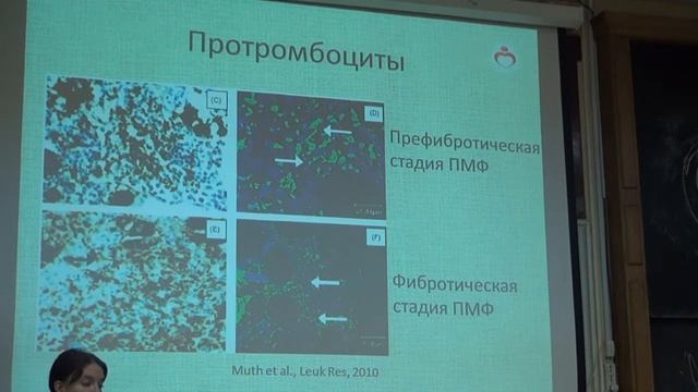 Патогенез первичного миелофиброза — клиническая и лабораторная практика  | Лекториум