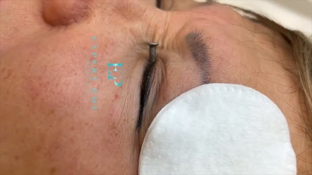 Удаление татуажа с век лазером смотреть онлайн