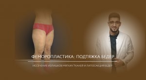 Феморопластика: подтяжка бедер