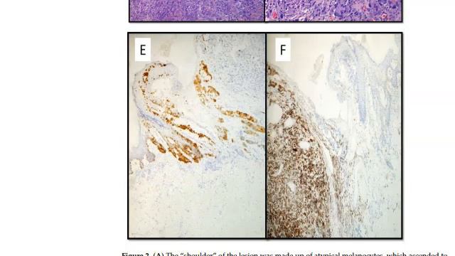 Melanoma - Science News and Research News