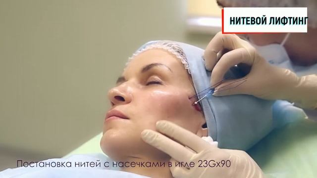 Нитевой лифтинг