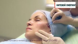 Нитевой лифтинг
