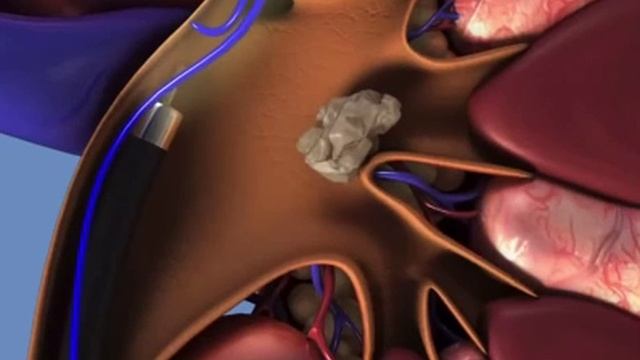 Удаление камня из почки. смотреть онлайн