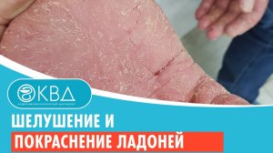✋ Шелушение и покраснение ладоней. Клинический случай №917