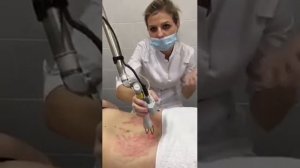 Лазерная шлифовка растяжек в ЦИДК