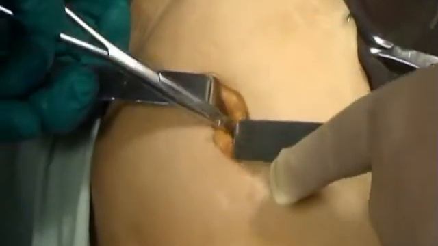 Формирование концевой илеостомы по Бруку смотреть онлайн