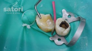 Восстановление зуба пломбой – стоматология Самара