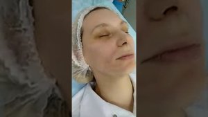 Пилинг Джесснера