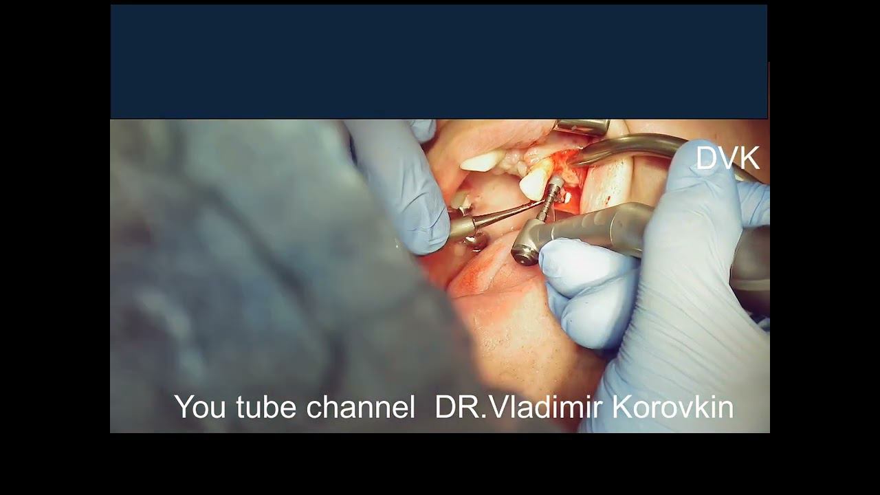 Insert implant ICX -Active 3,75- 10 - 24.