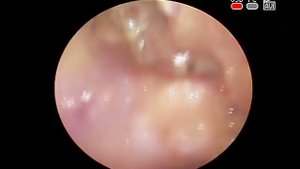 Рецидив опухоли твердого неба полости #рта #злокачественные новообразования #рак верхней челюсти