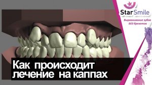 Как исправить скученность зубов? Пошаговый план перемещения зубов в элайнерах