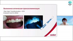 Часть 2. Диагностика начального кариеса, начальный кариес в современных классификациях