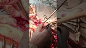 Удаление остеолитических участков лобной кости, 🧠удаление холестеотомы из лобной пазухи,🧠😊👍🙏🙏🙏