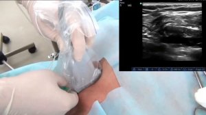 Подключичная блокада плечевого сплетения с катетеризацией