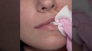 ?Аугментация (увеличение) губ филлером