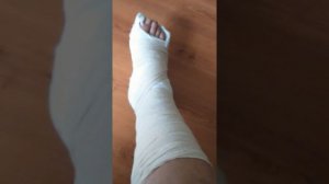 Перелом ноги┇5 недель в гипсе