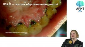 Вебинар «Отбеливание зубов у пациентов с абфракционными и клиновидными дефектами – это реальность?»