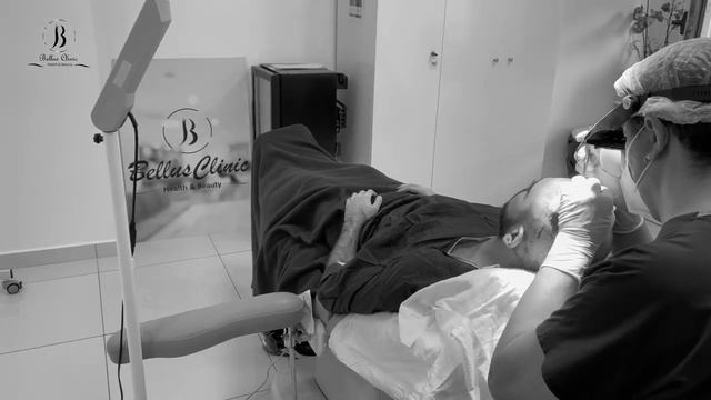 Результат пересадки волос в Bellus Clinic