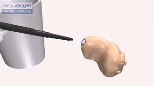 Замена серного фильтра внутриушного слухового аппарата