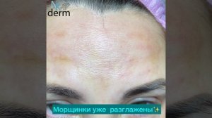 Убираем морщинки лба гиалуроновой кислотой.