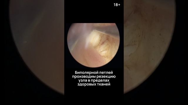 Удаление миомы путем гистероскопии. смотреть онлайн