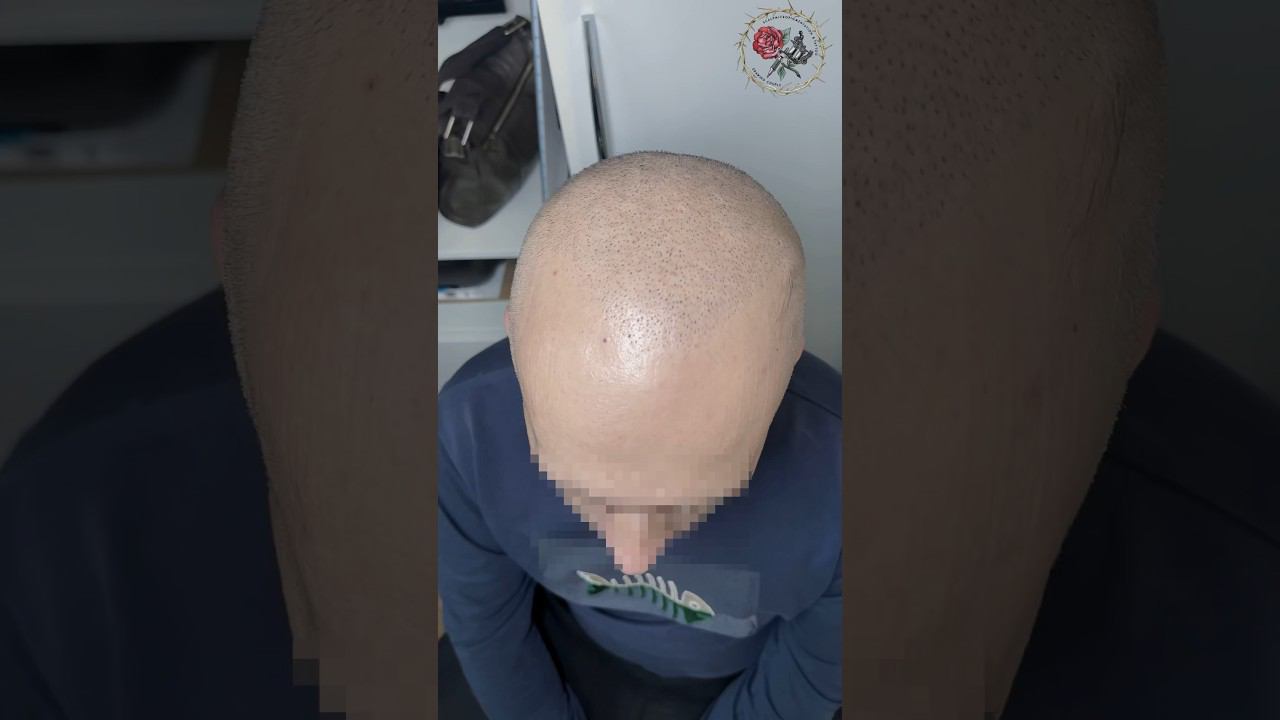 Трихопигментация после пересадки волос, затемнение кожи головы тату волос. Москва. SMP