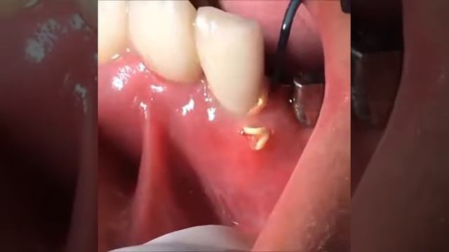 ГНОЙНЫЙ ЗУБИК смотреть онлайн