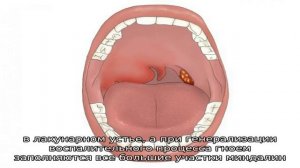 Гнойная ангина у взрослых