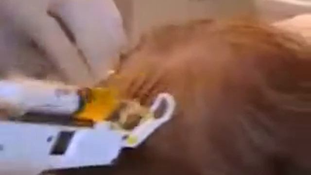 Мезотерапия для волос процедура проведения смотреть онлайн