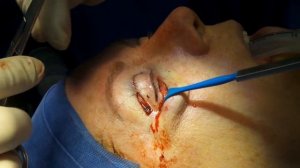 Cheek Lift during a Blepharoplasty Procedure