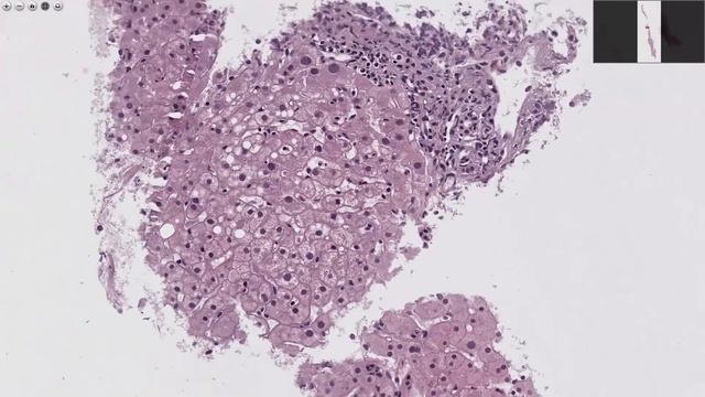 Подозрение на отторжение. Метастаз мелкоклеточного рака