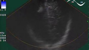 Детская Нейросонография (УЗИ головного мозга) - Образование теменной области головного мозга