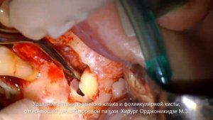 Удаление ретенированного клыка и фолликулярной кисты, оттесняющей дно гайморовой пазухи.