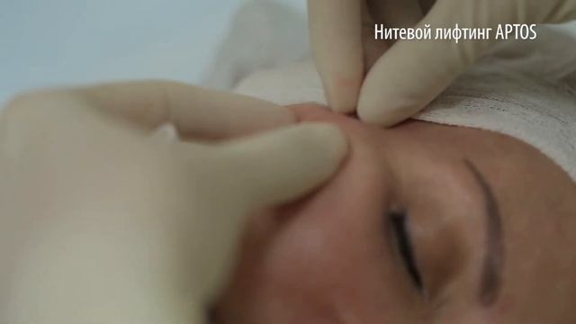 Нитевой лифтинг APTOS в GMTClinic