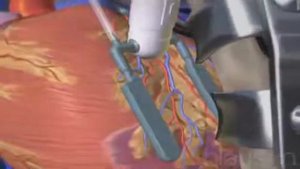 Кардиохирургия Аорто коронарное шунтирование коронарных артерий без АИК Стентирование хороша