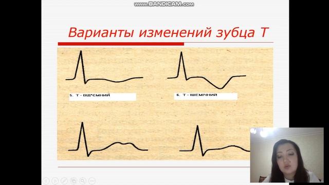 ИБС  Стенокардия