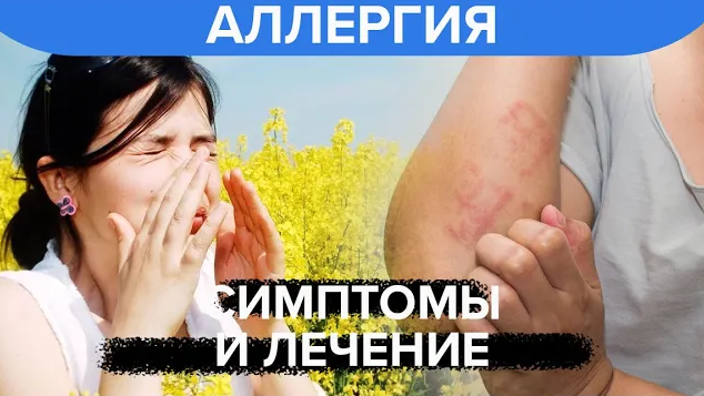 Аллергия: симптомы и лечение аллергии