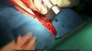 Стернотомия