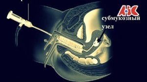 Гистероскопия матки.
