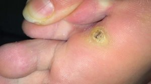 Бородавки. Бородавки у детей. Бородавки папилломы