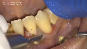 Зубной камень ?   YouTube