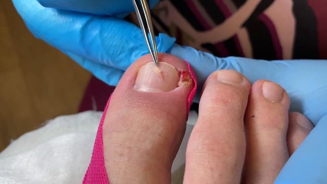 Вросший ноготь. Парень 15 лет. Мучается в течении месяца. Убрали за пару минут. смотреть онлайн