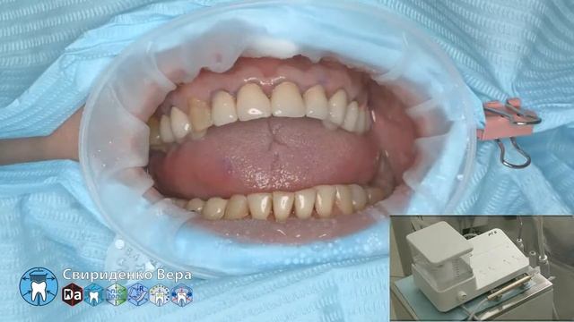 Professional oral hygiene -case 009 Acteon DTE Dentsply Coxo Floweis 3M KerrHawe (FHD multistream)