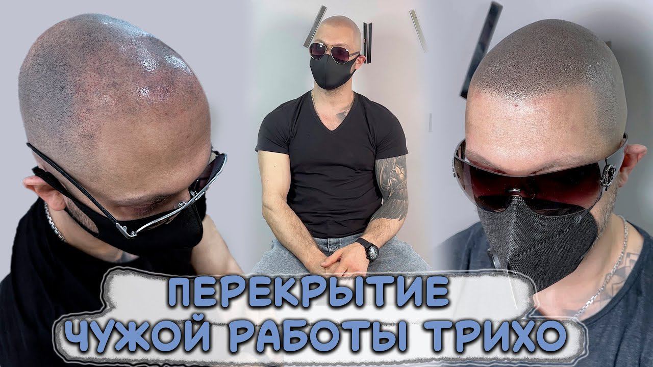 Перекрытие чужой работы трихопигментации после мастера татуажа Scalp Micropigmentation SMP