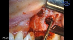 Открытый синус-лифтинг и имплантация при наличии септы