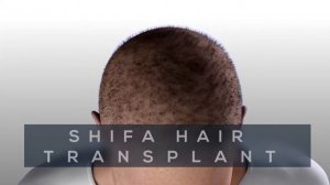 Shifahair центр трансплантации волос   лучший центр в Турции
