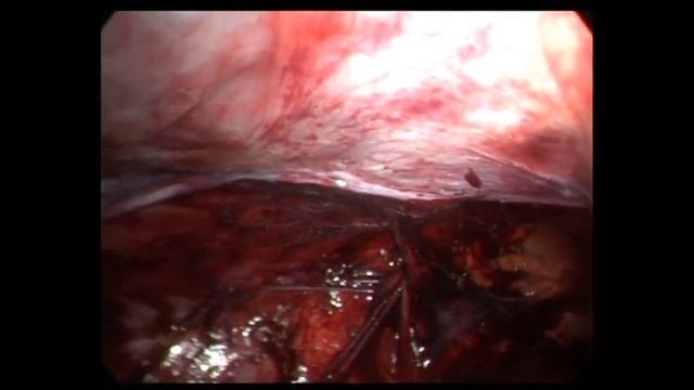 Лапароскопическая герниопластика