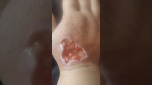 Укус собаки.Лечение.Самое ужасное видео.