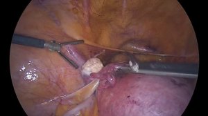 экстирпация матки // лапароскопическая гистерэктомия // TLH